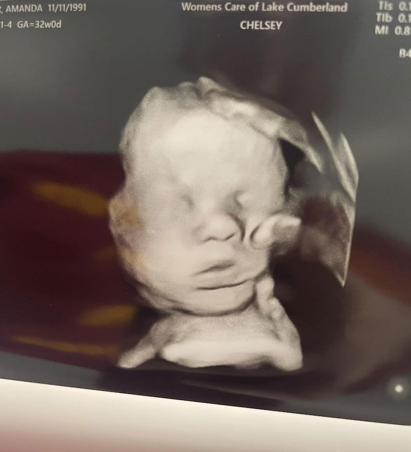 hand of god ultrasound picture